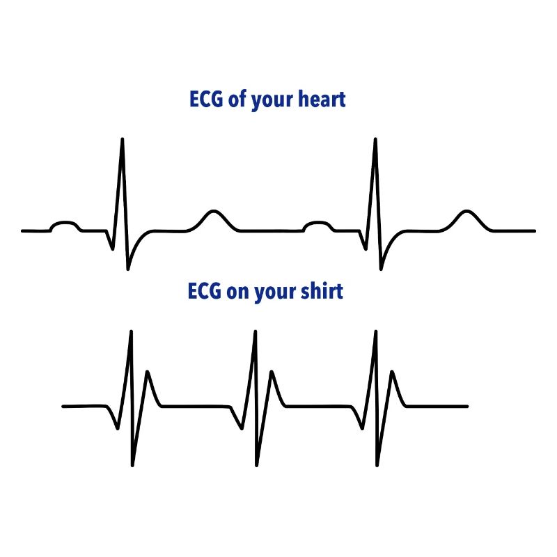 Électrocardiogramme (ECG) rythme réel vs mode