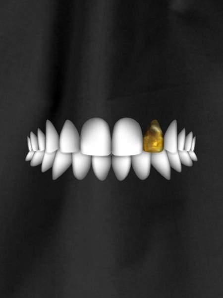 teeth with gold tooth