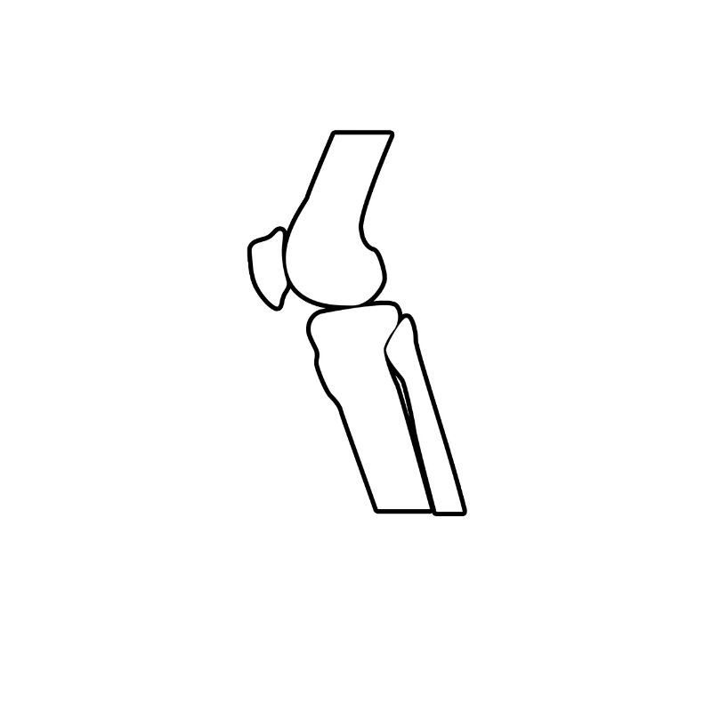 Knee replacement