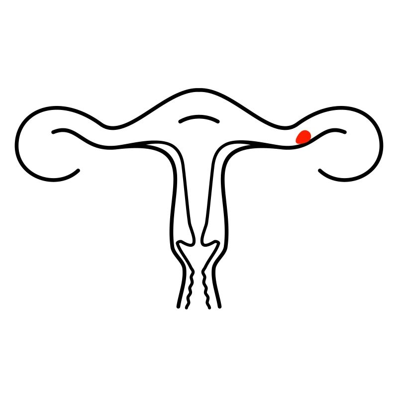 Schematische Gebärmutter (2c)