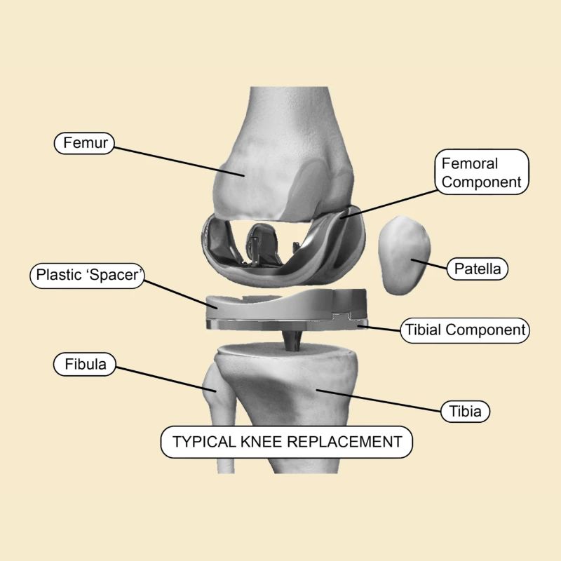 Knee components