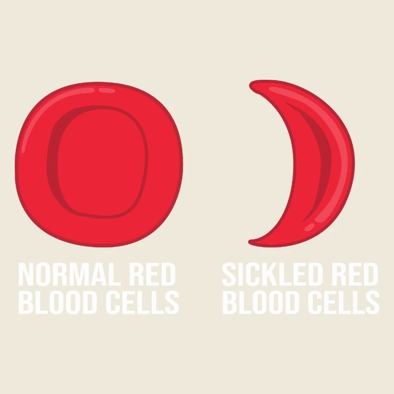 Sickle cell anemia