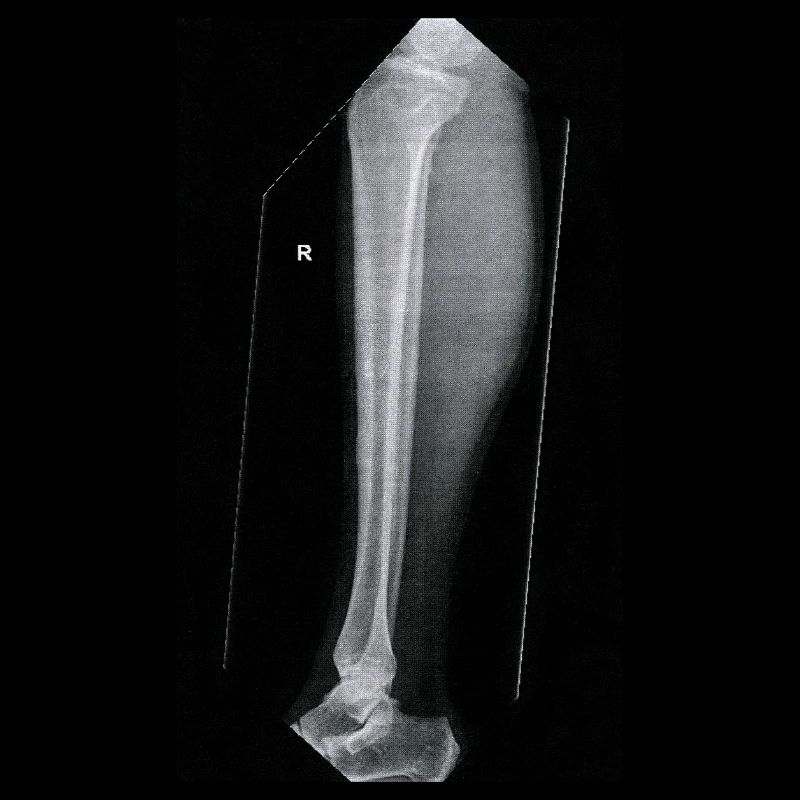 Leg Bone X-Ray