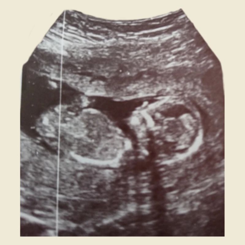 Babyloading... Please be patient! Ultrasound