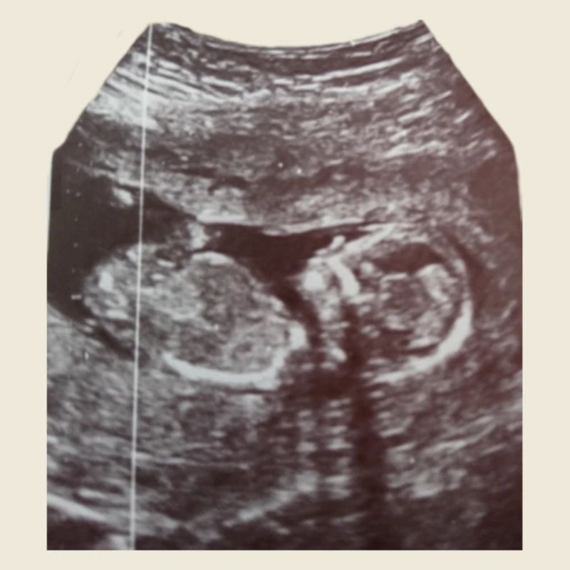Babyloading … Bitte noch etwas Geduld! Ultraschall