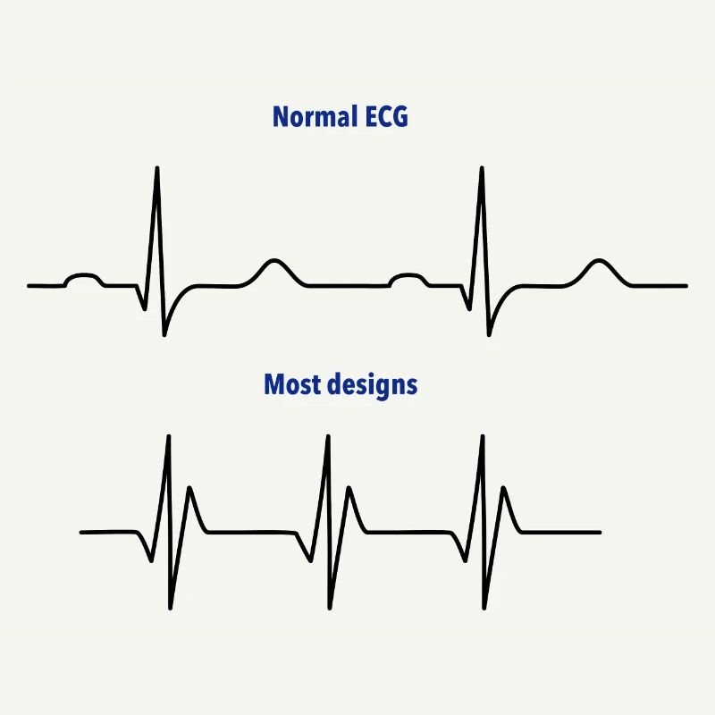 ECG normal vs ECG de conception