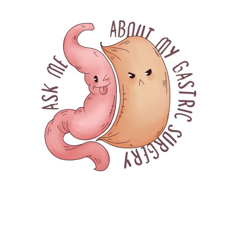 Sleeve gastrectomy sleeve gastrectomy