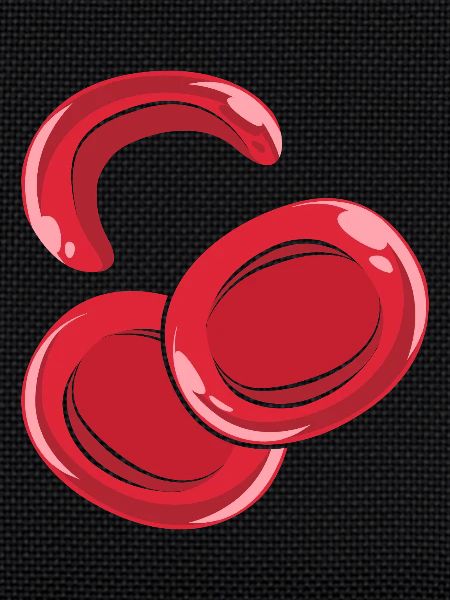 Sickle cell anemia