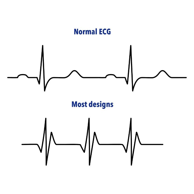 ECG normal vs ECG de conception
