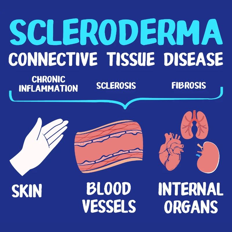 Scleroderma