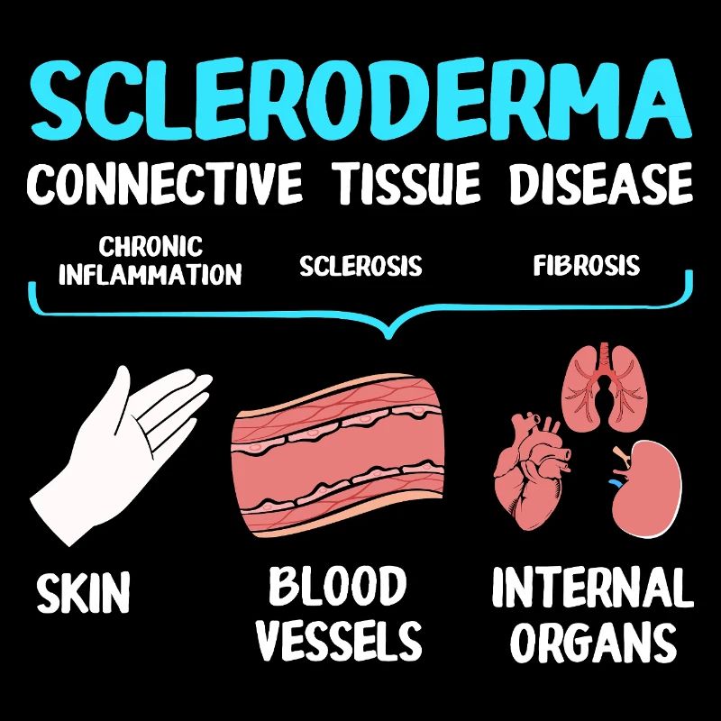 Sclérodermie