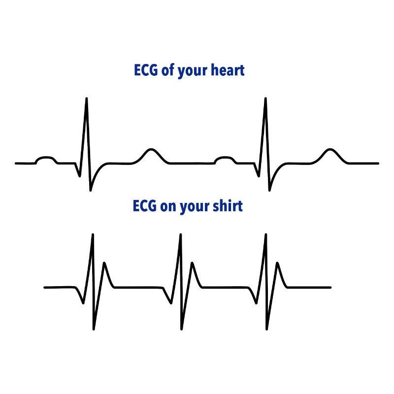 Elektrokardiogramm (EKG) echter Rhythmus vs. Mode