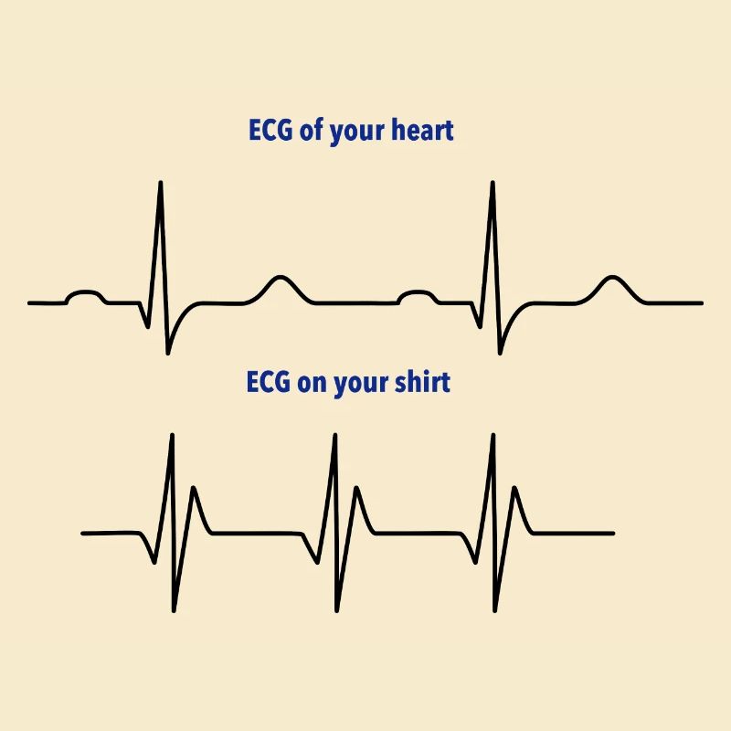 Elektrokardiogramm (EKG) echter Rhythmus vs. Mode