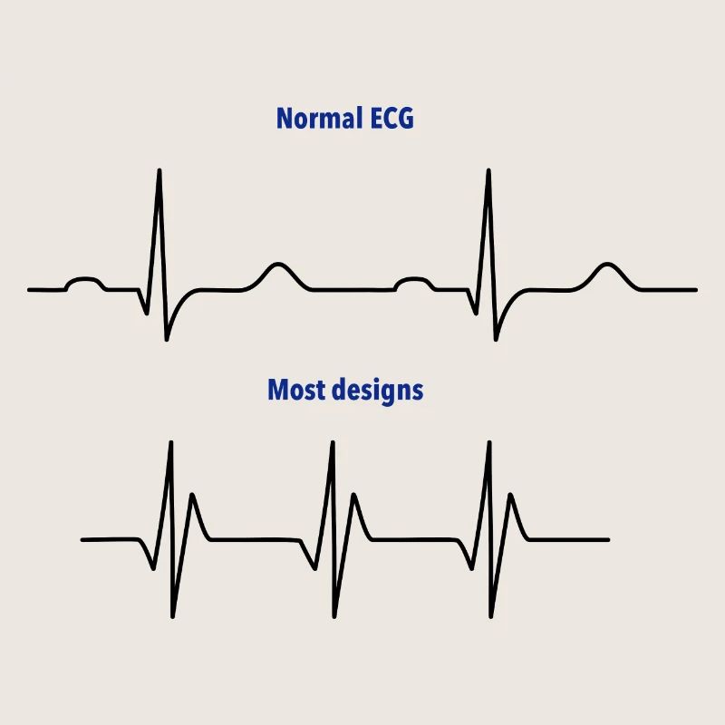 ECG normal vs ECG de conception