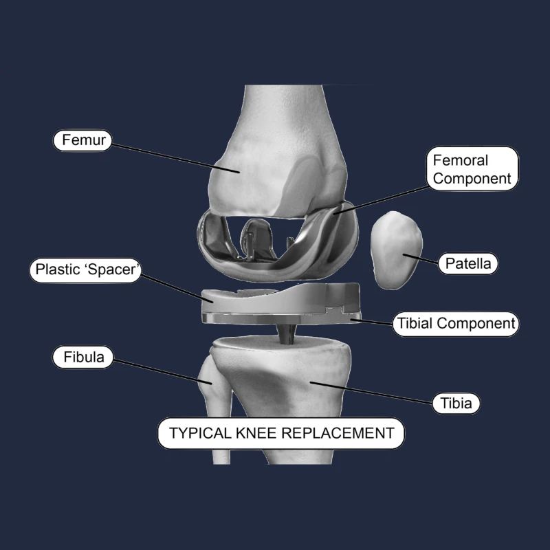 Knee components
