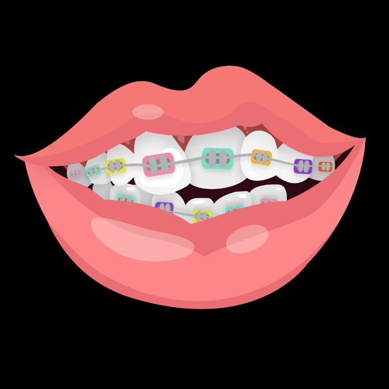 braces
