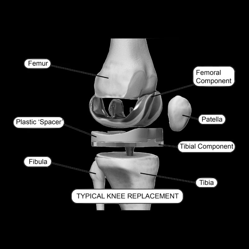 Knee components