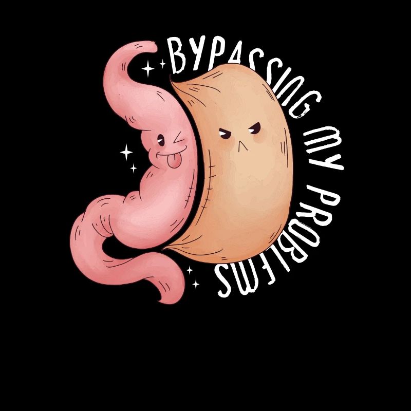 Sleeve gastrectomy sleeve gastrectomy