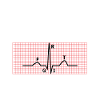PQRST EKG Wave elektrokardiogram sykepleiegave