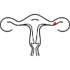 Schematic uterus (2c)