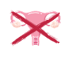 Hysterectomy