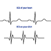 Électrocardiogramme (ECG) rythme réel vs mode