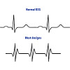 Normal ECG vs. Design ECGs