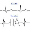 Electrocardiogram (ECG) - Normal versus Hä?