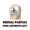 Medial Unicompartmental Knee Arthroplasty